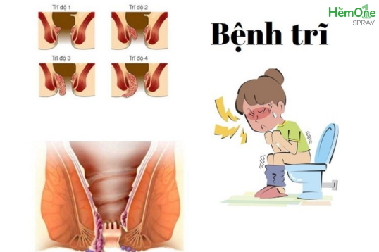 Nguyên nhân bệnh trĩ ngày Tết có thể bạn chưa biết