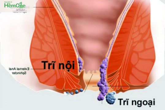 Điều trị bệnh trĩ tại nhà khi không đi khám trong Tết
